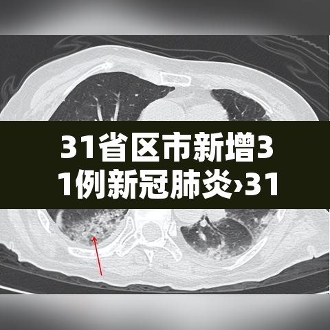 31省区市新增31例新冠肺炎›31省区市新增新冠肺炎确诊病例33例